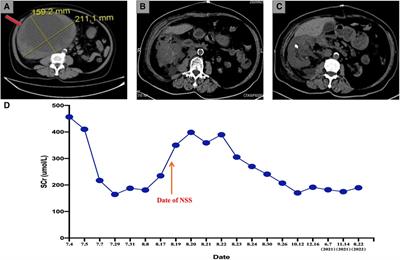 Nephron sparing surgery for a patient with a complicated solitary functioning kidney and a giant pT3 renal cell carcinoma: A case report